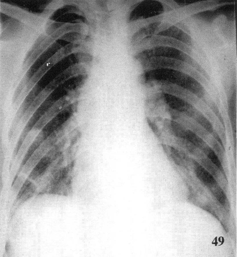 图2—49 骨癌肺转移
